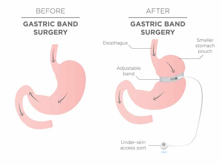 lap-band-removal-weight-loss-surgery-revision-seattle-wa